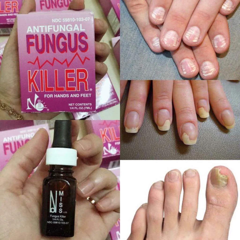 Antifungal Fungus Killer 1/4oz/7ml Full Size 1 Packs Made in USA - Image 3